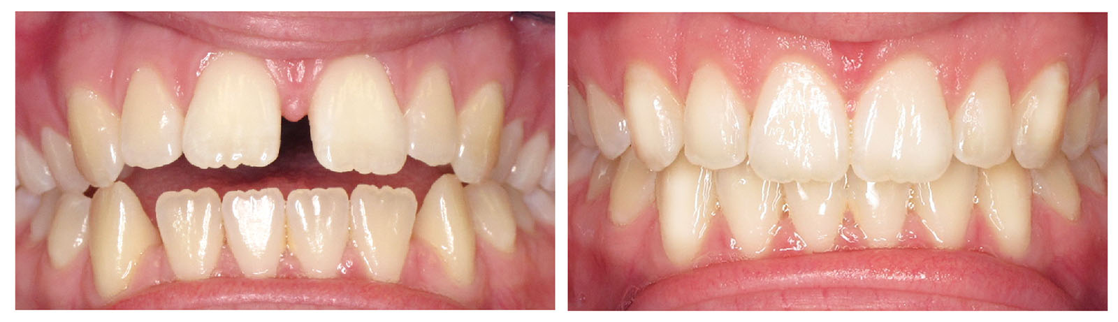 West Chicago Smiles | Preventative Program, All-on-6 reg and Implant Dentistry