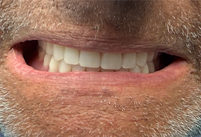 West Chicago Smiles | Cosmetic Dentistry, Veneers and Pediatric Dentistry