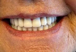 West Chicago Smiles | CBCT, ZOOM  Whitening and All-on-4 reg 