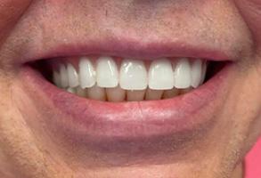 West Chicago Smiles | Implant Dentistry, ZOOM  Whitening and Sports Mouthguards