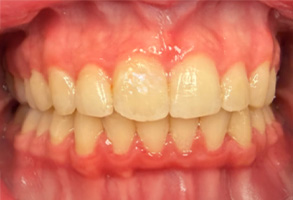 West Chicago Smiles | Night Guards, Periodontal Treatment and Dentures