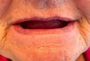 West Chicago Smiles | Digital Impressions, Dentures and All-on-4 reg 