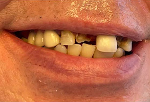 West Chicago Smiles | Dental Fillings, Dentures and Air Abrasion