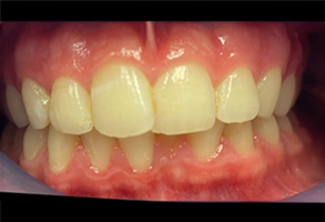 West Chicago Smiles | Periodontal Treatment, Ceramic Crowns and Preventative Program