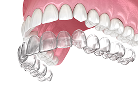 West Chicago Smiles | ViziLite   Plus, Night Guards and Full Mouth Reconstruction