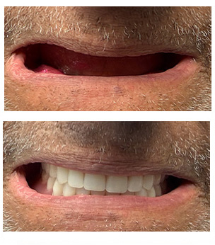 West Chicago Smiles | Ceramic Crowns, Periodontal Treatment and Digital Impressions