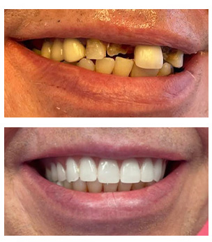 West Chicago Smiles | All-on-6 reg , Fluoride Treatment and Sports Mouthguards