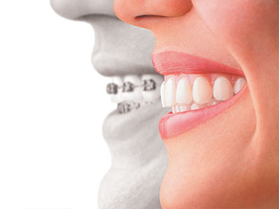 West Chicago Smiles | Full Mouth Reconstruction, Oral Exams and Air Abrasion