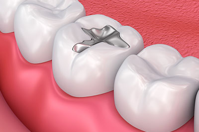 West Chicago Smiles | Implant Dentistry, Cosmetic Dentistry and Periodontal Treatment