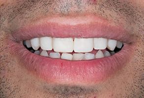 West Chicago Smiles | Digital Radiography, Veneers and Full Mouth Reconstruction