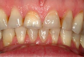West Chicago Smiles | Periodontal Treatment, Emergency Treatment and Digital Impressions