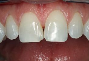 West Chicago Smiles | Air Abrasion, Digital Radiography and ZOOM  Whitening
